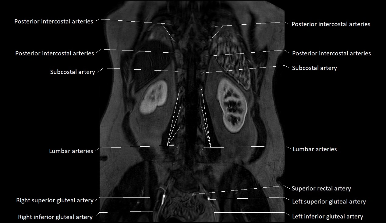 MRA Abdomen coronal anatomy image 50.webp